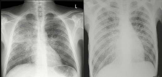 Chest x-rays from 2 HIV-infected patients with E. africanus infection diagnosed by skin biopsy and in whom pulmonary tuberculosis was excluded. (A) Diffuse, bilateral reticulonodular infiltrates. (B) Bilateral reticulonodular infiltrates with multifocal airspace disease and bilateral hilar involvement.