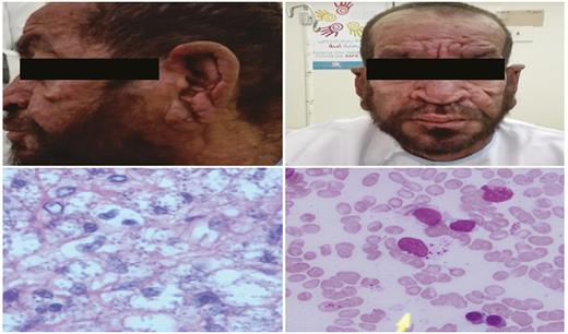 A and B, Cutaneous lesions with nodules and destruction of the nasal bridge. C, Skin biopsy with multiple Leishmania parasites (hematoxylin and eosin stain, magnification ×600). D, Bone marrow aspirate with sparse Leishmania parasites (Giemsa stain, magnification ×600).