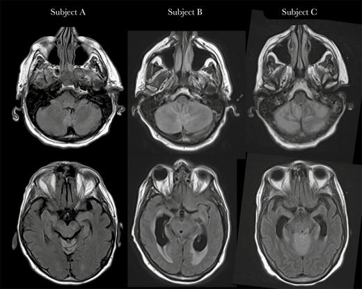 Brain magnetic resonance imaging findings. T2-fluid-attenuated inversion recovery sequences show hyperintensity in the cerebellum (top row) and brainstem (bottom row), consistent with rhombencephalitis, in Subject A after 4 days of symptoms, Subject B after 5 days of symptoms, and Subject C after 7 days of symptoms. While highly suspicious for POWV infection, other infectious etiologies as well as autoimmune diseases and paraneoplastic syndromes remain in the differential diagnosis, and confirmation by serology or viral RNA detection is required. Abbreviation: POWV, Powassan virus.