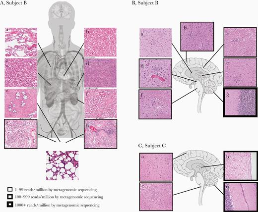 Correlation of autopsy histopathological findings with POWV detection in Subjects B and C. A, Autopsy tissue collected from Subject B included lung (a), heart (b), liver (c), spleen (d), prostate (e), kidney (f), right testicle (g), left testicle (h), and bone marrow (i). Foci of chronic inflammation were identified in the left testicle, while the remaining specimens showed minimal, nonspecific abnormalities without histological evidence of infection or recurrent lymphoma. B, Brain sections from Subject B included basal ganglia (a), frontal cortex (b), periventricular white matter (c), midbrain (d), thalamus (e), pons (f), and cerebellum (g). Findings of meningoencephalitis, including lymphocytic predominant leptomeningeal, perivascular, and parenchymal inflammation, microgliosis with microglial nodules and neuronophagia, and severe neuronal loss, were present throughout the brain and most predominant in the cerebellum. C, Brain sections from Subject C included frontal cortex (a), thalamus (b), medulla (c), and cerebellum (d). Histological abnormalities were similar to Subject B and most severe in the brainstem and cerebellum. All histological images are of hematoxylin and eosin–stained slides using a 20× objective. The quantity of virus detected by metagenomic sequencing (POWV reads/million) is indicated by the thickness of the boxes surrounding the histological images. Anatomy figures were obtained from Wikimedia Commons under Creative Commons CC0 1.0 Public Domain Dedication. Abbreviation: POWV, Powassan virus.