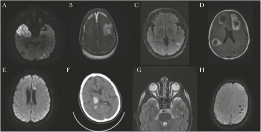 Select neuroimaging findings. A, Patient 2: MRI of the brain without contrast, axial DWI image showing diffusion restriction in the right middle cerebral arteries and left posterior cerebral artery territories. B, Patient 5: MRI of the brain with and without contrast, axial T2 weighted image showing left frontal parenchymal hemorrhage with surrounding mass effect and nonspecific mild diffuse dural thickening. C, Patient 7: MRI of the brain with and without contrast, axial fluid attenuated recovery image showing left parietal juxtacortical white matter hyperintensity. D, Patient 17: MRI of the brain with and without contrast, axial T1 postcontrast image showing multifocal hypointensities with surrounding enhancement in the left frontal lobe, right temporoparietal lobe, and inferior right frontal lobe with surrounding vasogenic edema. E, Patient 23: MRI of the brain with and without contrast, axial DWI image showing subacute infarct in the left frontal centrum semiovale. F, Patient 25: CT of the head without contrast, axial image showing right thalamic intraparenchymal hemorrhage with associated mass effect on the right lateral ventricle. G, Patient 26: Axial MRI orbits with and without contrast: T2 weighted image showing mild kinking of the intraorbital optic nerves and mildly distended optic nerve sheaths bilaterally. H, Patient 27: Axial MRI of the brain without contrast: susceptibility weighted imaging showing hemorrhagic infarct of the left perirolandic region. Subacute subdural hematoma at the right frontoparietal lobe. Abbreviations: CT, computed tomography; DWI, diffusion weighted imaging; MRI, magnetic resonance imaging; SWI, susceptibility weighted imaging.