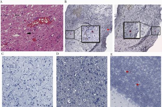 Brain biopsy specimen from 1996 revealed human immunodeficiency virus (HIV) deoxyribonucleic acid (DNA)+ cells by in situ hybridization (ISH). (A) Mild lymphocytic infiltrate and reactive gliosis was identified by routine hematoxylin and eosin and immunohistochemistry staining of formaldehyde-fixed, paraffin-embedded brain specimen. Black arrowhead points to a lymphocyte; block arrow idenitifes a reactive astrocyte. (B and C) By ultrasensitive DNAscope (B) and RNAscope (C) ISH using the HIV-1 clade B probe covering gag, pol, vif, vpr, tat, rev, vpu, env, and nef regions, cells bearing HIV DNA in 2 sections (insets and red arrow, left and right columns, B), but not ribonucleic acid (C), were detected. (D and E) Uninfected (D) and HIV-infected brain specimens (E) were used as controls.