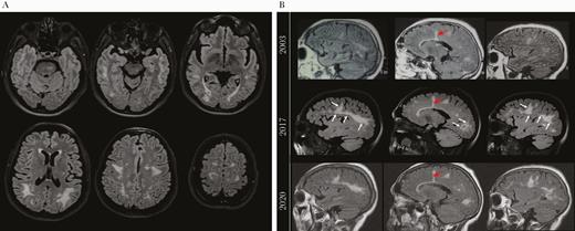 Brain magnetic resonance imaging (MRI) showed persistent diffuse white matter disease since 1996. (A). Axial T2 fluid-attenuated inversion recovery (FLAIR) images show multiple bilateral confluent hyperintensities most prominently affecting the white matter of the posterior frontal, parietal, and temporal lobes with relative sparing of the subcortical U-fibers. Additional abnormal signal intensity lesions were seen in the midbrain and pons. (B) Sagittal T2-FLAIR images (midsagittal and parasagittal) obtained in 2003, 2017 (National Institutes of Health), and 2020 show persistent white matter lesions on sequential scans, with possible worsening between 2003 and 2017 (white arrows) that likely reflects varying MRI technique. Also shown is the linear hyperintensity remaining from the 1996 biopsy (red arrows).
