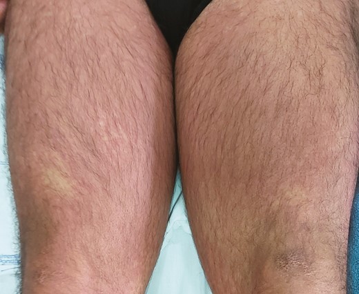 Reddish maculopapular, nonpruritic rash on both thighs.