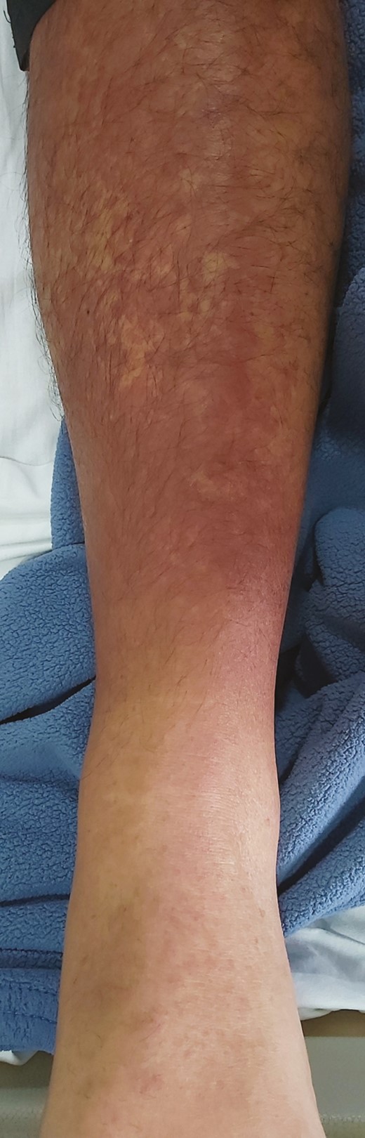 Purpuric rash in the distal third of the lower limbs (picture taken on day 8 of symptoms).