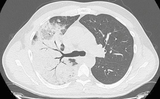 Chest computerized axial tomography showing multilobar consolidation, primarily in the right upper lobe.