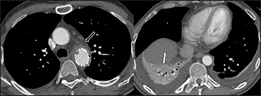 Axial CT angiogram sections below the level of the aortic arch, performed on June 11, 2017. Soft tissue thickening and stranding surrounding the descending thoracic aortic stent graft concerning for graft infection (black arrow). There is no mediastinal fluid collection. There is right lower lobe consolidation and/or collapse (white arrow) and small bilateral pleural effusions. Abbreviation: CT, computed tomography.