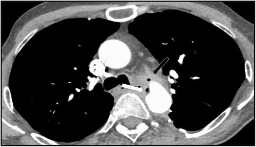 Axial contrast-enhanced CT section at the level of the aortic arch, performed on October 9, 2019 (32 months post–thoracic aortic Dacron graft placement). Unchanged Dacron interposition graft replacement of the descending thoracic aorta, with persistent mediastinal soft tissue formation anterior to the graft at the level of the distal anastomosis (black arrow), more air within the abnormal soft tissue formation, as well as more irregularity and mild narrowing of the anterior aspect of the distal anastomosis (white arrow), consistent with ongoing infectious process. Abbreviation: CT, computed tomography.