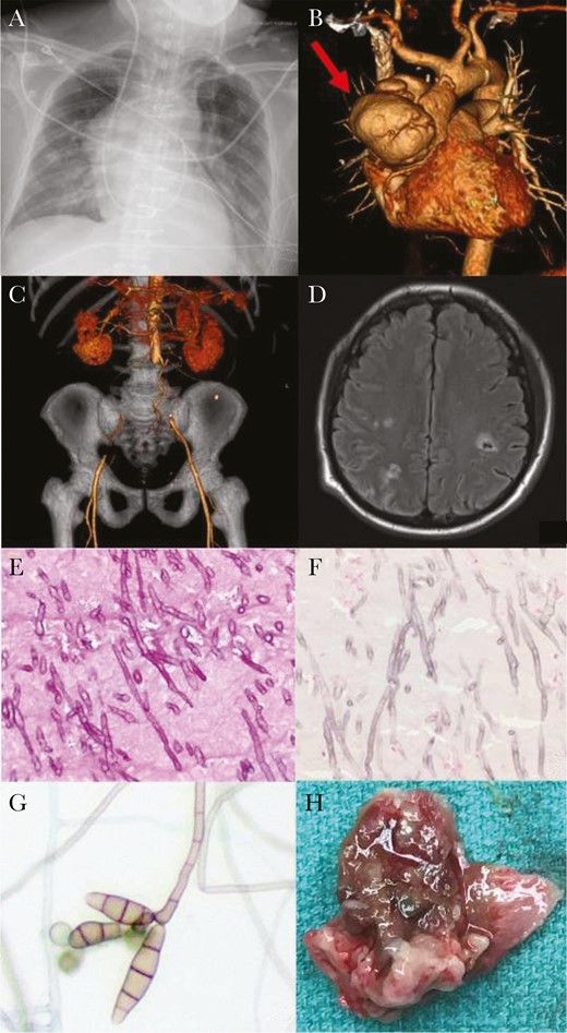 Radiographic, histopathological, and microbiological results. A, Anteroposterior erect chest radiograph on presentation demonstrating large aortic aneurysm. B, Computed tomography (CT) angiogram reformats on presentation: red arrow indicating ascending aortic aneurysm. C, CT angiogram reformats on presentation: coronal view, demonstrating absence of blood flow through bilateral iliac arteries. D, Magnetic resonance imaging of the head demonstrating septic cerebral emboli. E, Periodic acid-Schiff stain of the aortic thrombus, 400×, showing narrow, septate fungal hyphae with acute angle branching. F, Fontana-Masson stain, 400×, demonstrating melanin uptake in the fungal cell wall. G, Lactophenol cotton blue stain of the Curvularia alcornii recovered in culture. H, Macroscopic “fungal ball” from ascending aorta.
