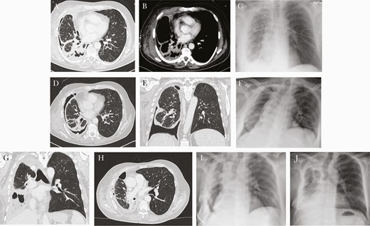 Initial computed tomography scan (a and b) and postoperative x-ray (c) after rethoracotomy and pleurectomy/decortications. Computed tomography scan 4 weeks later with persistent bronchopleural fistula and re-empyma (d and e) + postoperative x-ray after right lower lobectomy (f). Computed tomography scan another 4 weeks later with re-empyema and bronchial stump insufficiency (g and h) and postoperative x-ray after middle lobe lobectomy + latissimus dorsi flap (i). Final x-ray after discharge 3 weeks later (j).
