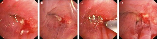 Bronchoscopy images showing bronchial stump insufficiency 4 weeks after right lower lobectomy.