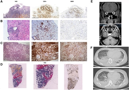 Pathological and radiological illustrations of EBV-induced lymphoproliferation. Multiorgan dysfunction due to CD3+ CD8+ CD30+ EBER+ cytotoxic T-cell infiltrate. For each biopsy, the CD8+ and EBER+ character is confirmed (A–D). In detail, oral aphthous biopsy showed atypical lymphoproliferation with epitheliotropism corresponding to hydroa vacciniforme-like (A). Liver biopsy revealed sinusoidal and portal infiltrate (B). Renal biopsy showed a massive tubulointerstitial infiltrate without glomerulopathy or vasculopathy (C). Skin biopsy showed a diffuse nodular infiltrate of the dermis and hypodermis (D). Axial (low) and coronal (top) contrast-enhanced T1 magnetic resonance imaging of the orbits showed multilocal edema and enlargement of the various ocular muscles (E). Chest CT showed pleural and pericardial effusion (F). Abbreviations: CT, computed tomography; EBV, Epstein-Barr virus.