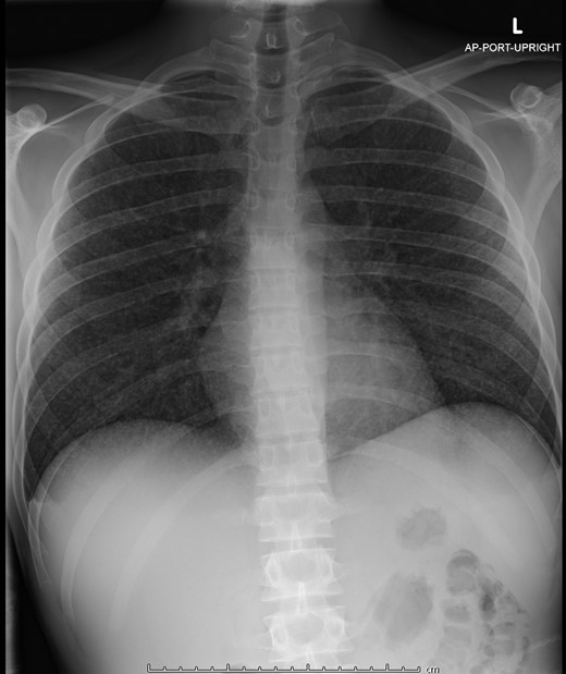 The patient’s initial chest x-ray showing innumerable diffuse, tiny pulmonary nodules bilaterally.