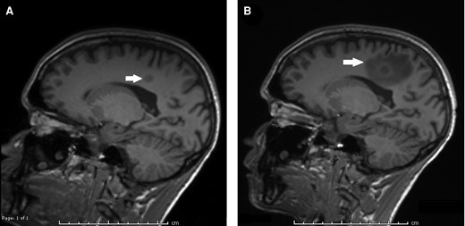 MRI of the brain with contrast, with T1 MP-RAGE sequences shown. A, MRI of the brain obtained at the time of initial TB diagnosis, showing a 1.0 × 1.2 cm area of enhancement in the right mesial parietal lobe. B, MRI of the brain obtained at the time of re-presentation and diagnosis with CNS TB-IRIS. The previously seen area of enhancement is slightly increased in size to 1.0 × 1.3 cm, and there is new surrounding vasogenic edema, measuring 4.5 × 2.3 cm. Abbreviations: CNS, central nervous system; MRI, magnetic resonance image; TB, tuberculosis; TB-IRIS, immune reconstitution inflammatory syndrome to tuberculosis.