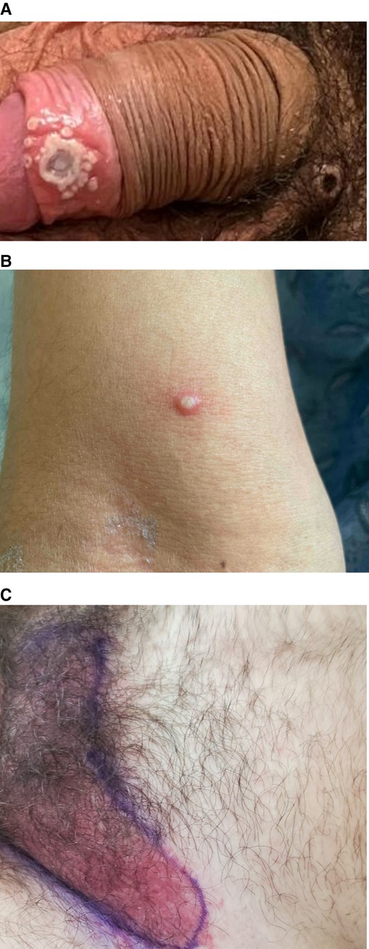 Cropped clinical images of case patients treated with tecovirimat. We highlight here the diverse clinical manifestations in our patients. A, Vesiculopustular lesion with surrounding satellite pustules on the foreskin of Case 1. Note additional scabbed lesion on the pubis. B, A pustular lesion on the arm of Case 2. C, The erythematous perineal rash that prompted administration of broad-spectrum antibacterial for Case 3. Not pictured is the vesicular component.