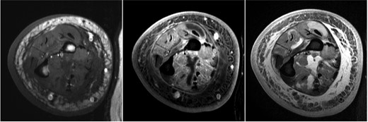Magnetic resonance imaging on presentation showing skin thickening, subcutaneous reticulations, and microabscesses consistent with pyomyositis (left, T1; middle, T1F; right, T2FS).