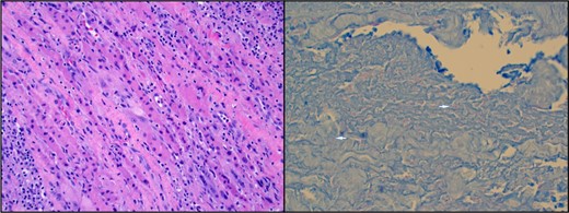 (Left) Hematoxylin and eosin stain of muscle biopsy revealing skeletal muscle cells with poorly defined borders, cellular swelling, pale cytoplasm, and associated white blood cells representing tissue in various stages of necrosis. (Right) Acid-fast bacilli muscle stain. Two bright pink filamentous shapes represent rare acid-fast bacilli within the muscle special stain (see arrows).