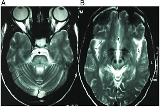 MRI brain T2-weighted image shows abnormal hyperintensity in pons with characteristic hypointense ‘trident’ sign (A) and characteristic ‘face of giant panda’ sign in midbrain (B).