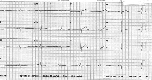 ECG on admission.