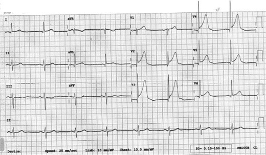 ECG 30 minutes after admission.