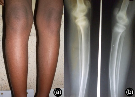 Image shows bilateral genu valgum deformity of patient (a) and X-ray lower limbs (b).