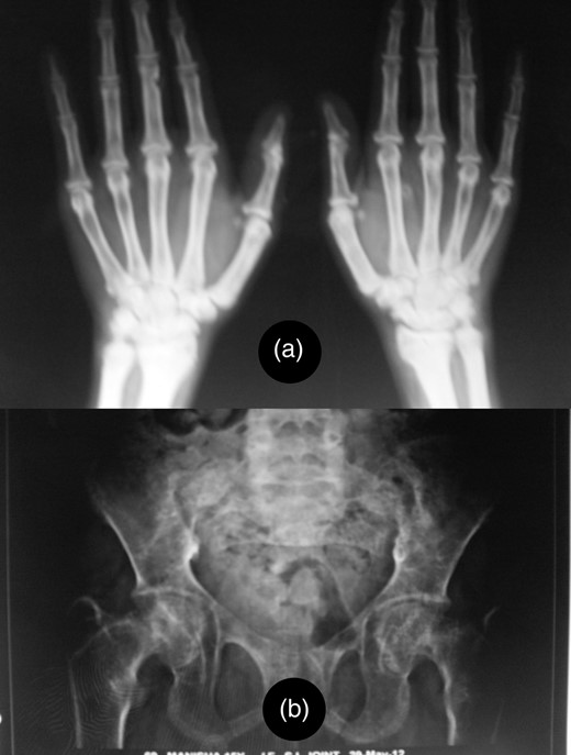 Image shows terminal osteolysis (a) and diffuse osteopenia with multiple bone cysts (b) in X-ray of the hand and pelvis.