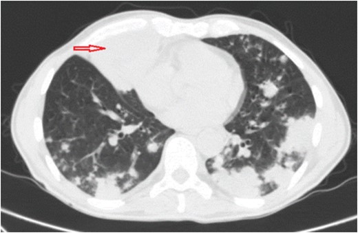 Chest CT scan shows multifocal bilateral pulmonary consolidations and right anterior inferior paramediastinal abscess measuring ~7 cm LG × 5.8 cm AP × 6.7 cm TV (red arrow).