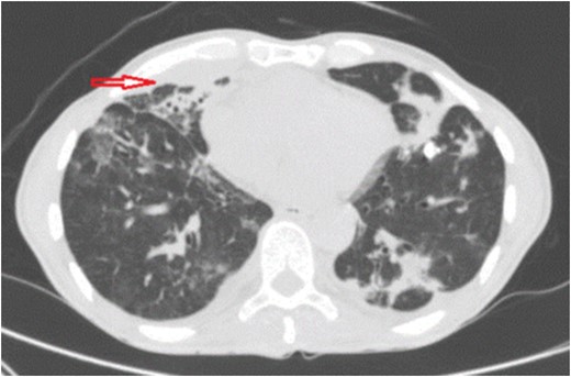 Chest CT scan shows interval resolution of paramediatinal abscess (red arrow) after percutaneous drainage and resolution of lung infiltrates after 2 weeks.