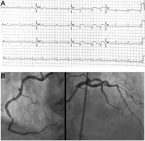 (A) ECG recordings at admission. ST elevation in v1-v3 leads; (B) Coronary angiography demonstrating patent coronary arteries without significant disease.