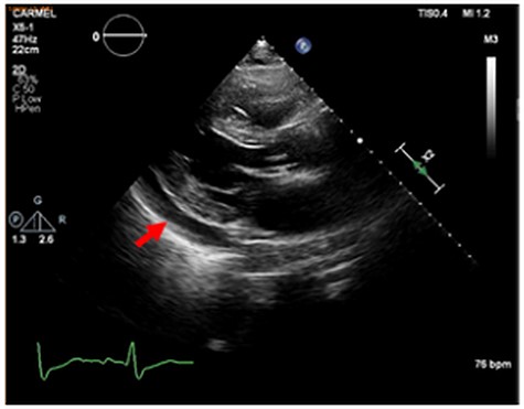 Echocardiographic study, long axis view. Red arrow marks pericardial effusion.