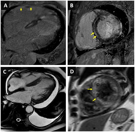 Cardiac magnetic resonance imaging. (A) Late gadolinium enhancement of the right ventricular free wall; (B) Mid-wall septal late gadolinium enhancement; (C) Moderate pericardial effusion and small left-sided pleural effusion; (D) High signal intensity in T2 weighted images.
