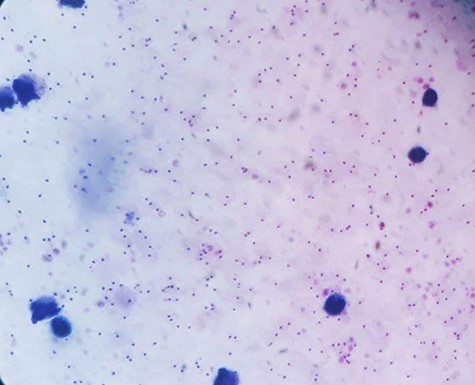 Blood film took on the first day showing a very high density of P. falciparum malaria.