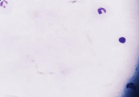 Blood film took before discharging the patient to ensure the parasitological clearance of malaria.