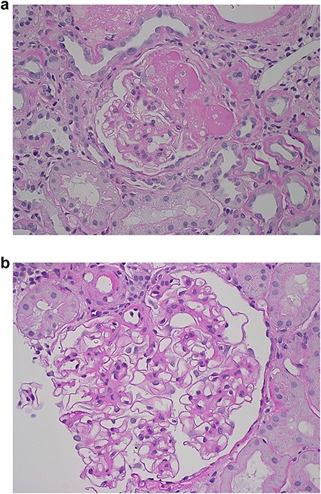 Representative sections from the biopsy of the patient’s left kidney, H&E stain.