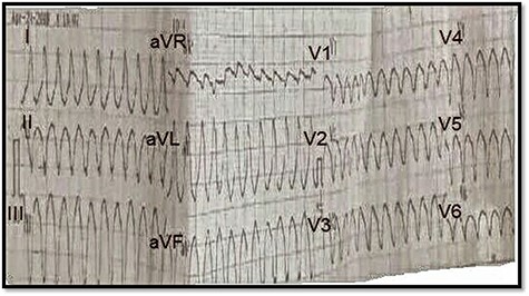 ECG on presentation, showing sustained wide QRS tachycardia (VT) that mimic LBBB morphology in superior axis.