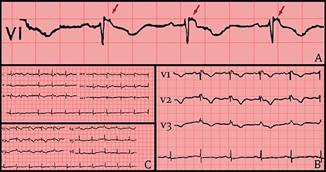 (A) 12 leads ECG after hemodynamic stability. (B) ECG shows RBBB morphology, T-wave inversion and Epsilon waves on precordial leads. (C) Epsilon waves on lead V1 (red arrows).