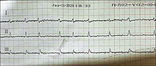 ECG showing atrial fibrillation during follow-up.