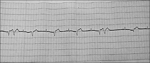 Last hospitalization, ECG showing AF with PVCs.