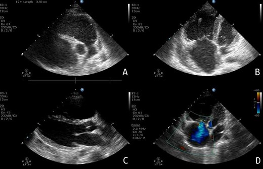 Echocardiography: (A) PSAX view, showing the extent of RV enlargement (PSAX RVOT = 35 mm). (B) Apical view of the four chambers, showing enlargement of the right-side chambers. (C) PLAX view. (D) Apical view of the four chambers, showing tricuspid valve insufficiency.