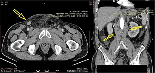 (A) Enhanced computed tomography (CT) scan of the abdomen and pelvis, axial view, showing right inguinal lymphadenopathy (arrow). (B) Coronal view of the enhanced CT scan of the abdomen showing retroperitoneal lymphadenopathy (arrow).