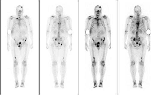 Skeletal scintigraphy with 99mTc-MDP showing bone metastases (marked dark with concentrated radiotracer).