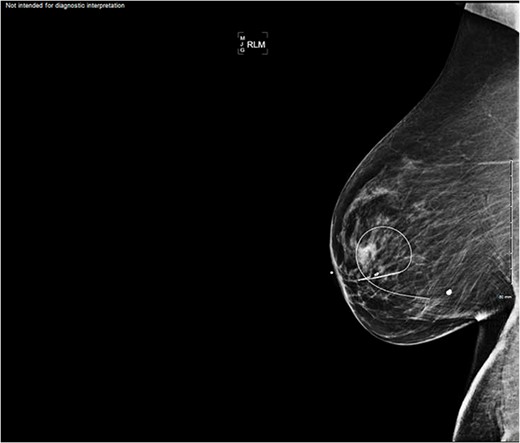 Imaging of the right breast mass at the 7 o’clock position measuring 4.6 × 3.5 × 3.6 cm.