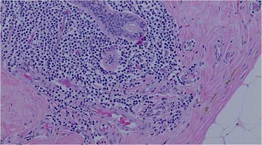 Atypical lymphoid cell population infiltrating the breast duct.