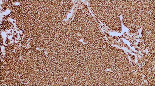 Immunohistochemical staining positive for B-cell marker CD20.