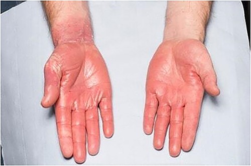 Bilateral well-demarcated erythema of both hands, with desquamation on the right hand side.