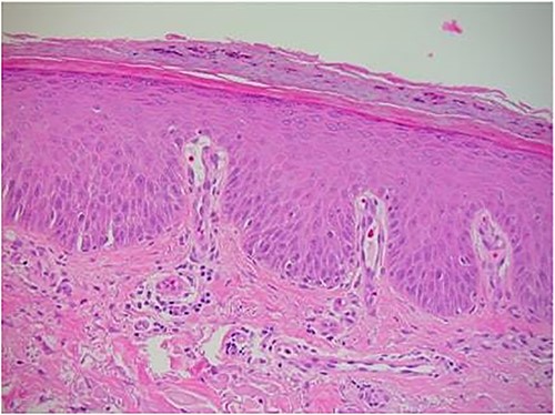 Mild basal epidermal spongiosis with prominent dilated capillaries in the dermal papillae (haematoxylin and eosin).