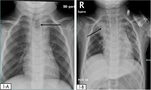 (A) initial CXR in the ED: reveals a round radiolucent object seen lateral to the trachea on the left side with mild widening of the mediastinum and clear lung fields. (B) Repeated CXR 4hrs after, an endotracheal tube is observed and there is an opacity in the right upper lung likely due to aspiration.