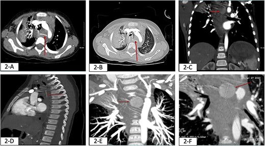 Findings of chest CT on the day of patient presentation (red arrows). (A) axial view: shows hyperdense object seen in the posterior mediastinum likely within the esophagus. (B) Axial and lung window view: hyperdense subject seen in the posterior mediastinum and there is consolidation in the right upper lobe (aspiration). (C) Coronal view: hyperdense object (FB) seen in the posterior mediastinum. (D) Sagittal view: hyperdense FB seen in the posterior mediastinum. Maximum intensity projection (MIP) imaging revealed a round hyperdense FB measure it 18.1 mm seen in the posterior mediastinum in multiple views, (E) Coronal view, (F) sagittal view.