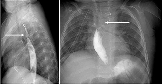 Fluoroscopy on day 7 post-op: revealed a narrowing of the upper esophagus (white arrows) with passing contrast to the lower esophagus and stomach.