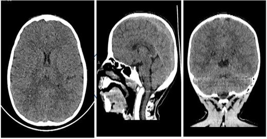 Axial, sagittal, and coronal views (from left to right) showing no abnormalities.